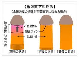 亀頭直下埋没法